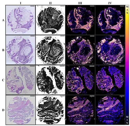 Photothermal MIRSI images of cervical cancer and ovarian cancer acquired by the handheld instrument closely match the corresponding data from a benchtop system. Scale bars are 200 microns. Credit: Rohith Reddy, University of Houston/Optica.