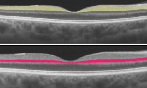 Thinning macular layers associated with atrial fibrillation. Credit: Moorfields Eye Hospital.