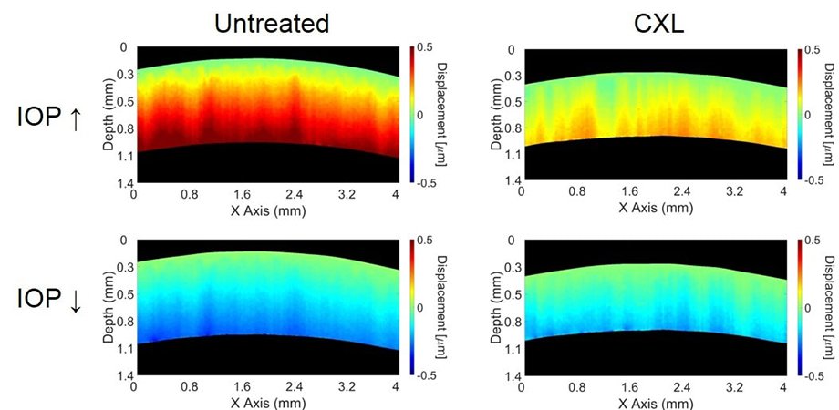 OCE detects changes in stiffness of untreated and crosslinked corneas as a response to intraocular pressure. Credit: SPIE/University of Houston.