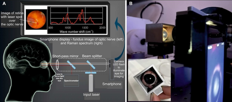 Concept and design of the EyeD with a 3D-printed phantom eye-model mimicking the optical properties of the eye, allowing Raman spectra through an eye-like lens to be acquired on model samples and optimizing of the resolution and optical throughput. Credit: the researchers and Science Advances.
