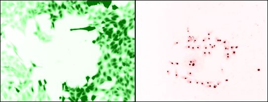 Living cells (left), and dead cells after PDT (right). When the correct compound is irradiated by the correct source, aggressive chemical species are produced and proceed to attack the cancerous cells. Credit: Theralase.
