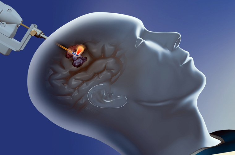 Brainwave: Monteris's NeuroBlate System offers a comprehensive laser ablation system.