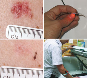 Light-emitting bandage