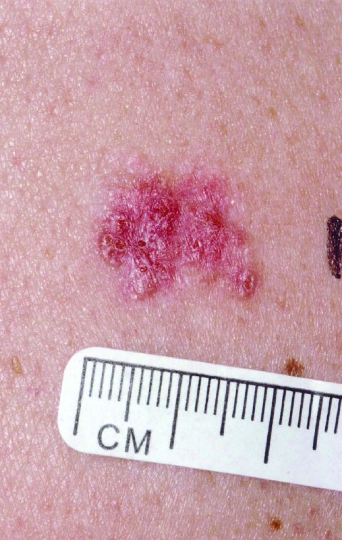 Skin cancer Skin cancer