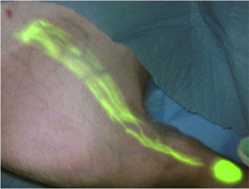 NIR fluorescence imaging shows hidden detail