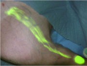 NIR fluorescence imaging shows hidden detail