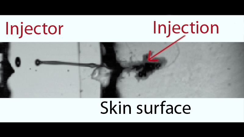 How the laser pulse-driven injectant passes through the skin into a patient’s tissue.