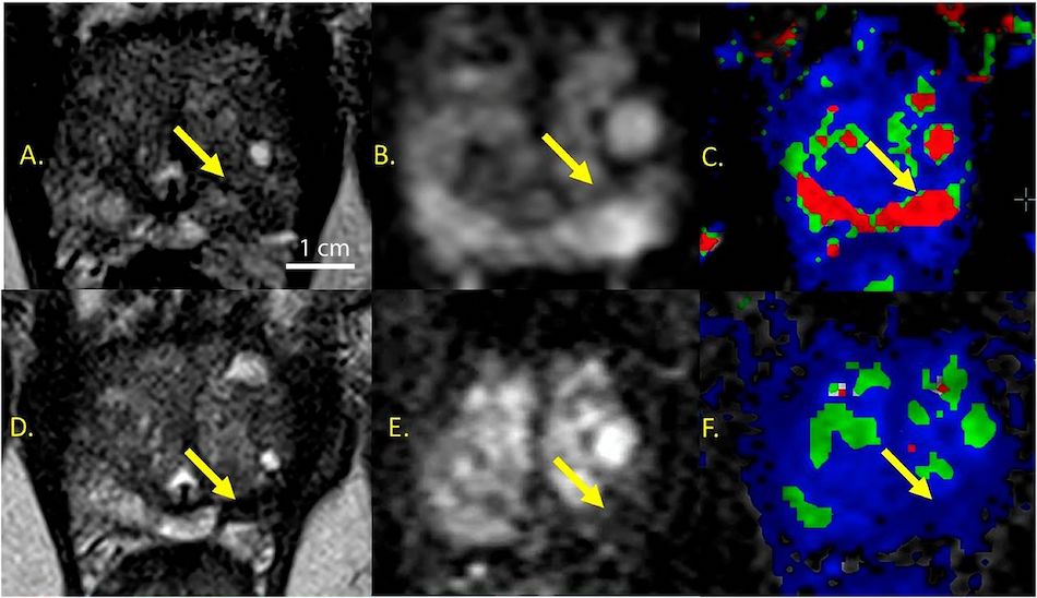 Hot spots: localized ablation