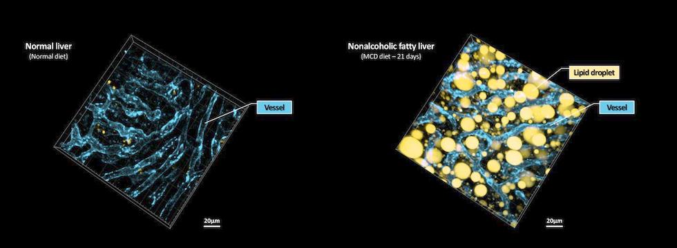 Disease progression: NAFLD