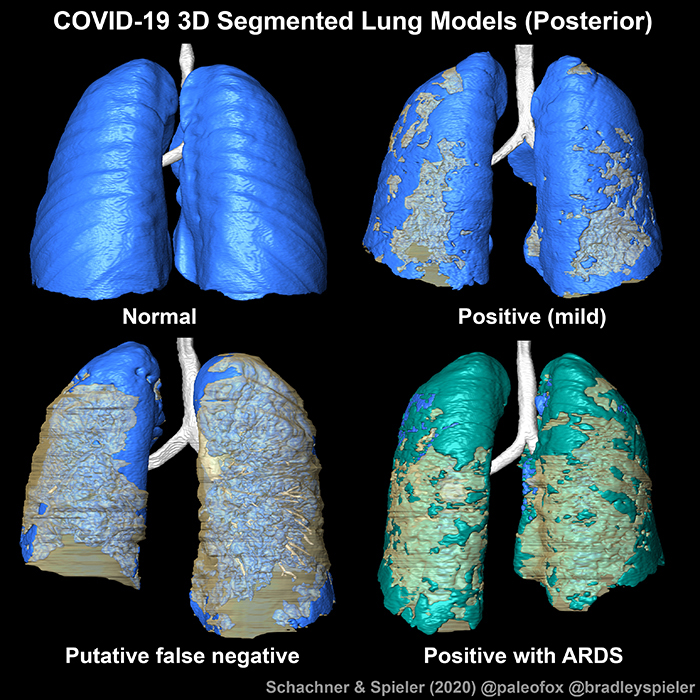 New Orleans team improves imaging diagnosis of Covid-19. Click for info. New Orleans team improves imaging diagnosis of Covid-19. Click for info.