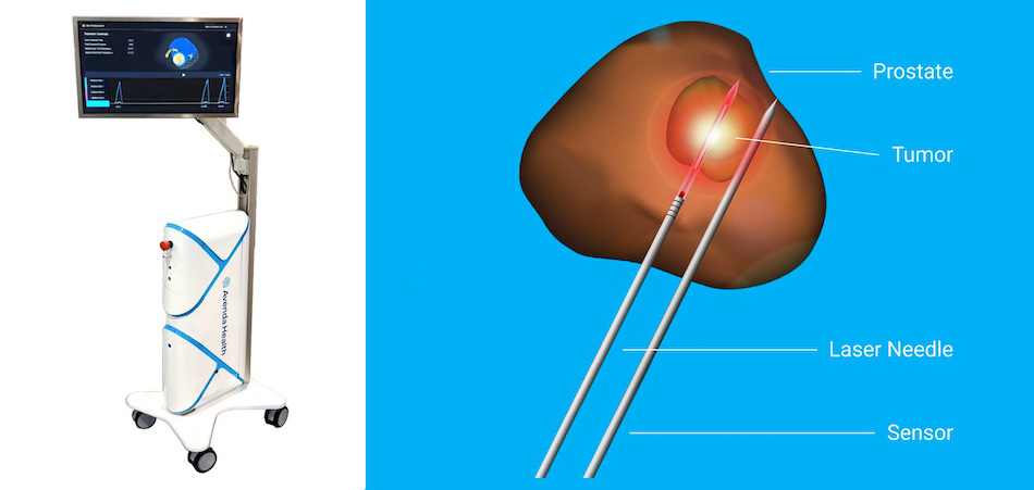 Focused therapy: laser ablation of prostate tumor Focused therapy: laser ablation of prostate tumor