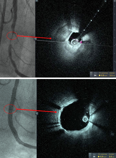 Images from first patient treated with HF-OCT at Tampa. Click for more info. Images from first patient treated with HF-OCT at Tampa. Click for more info.
