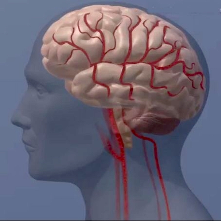 Early warning: neck arteries filmed by phone