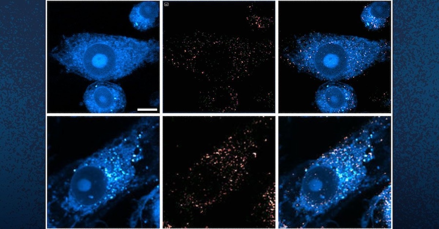 Disease progress: the role of lipids