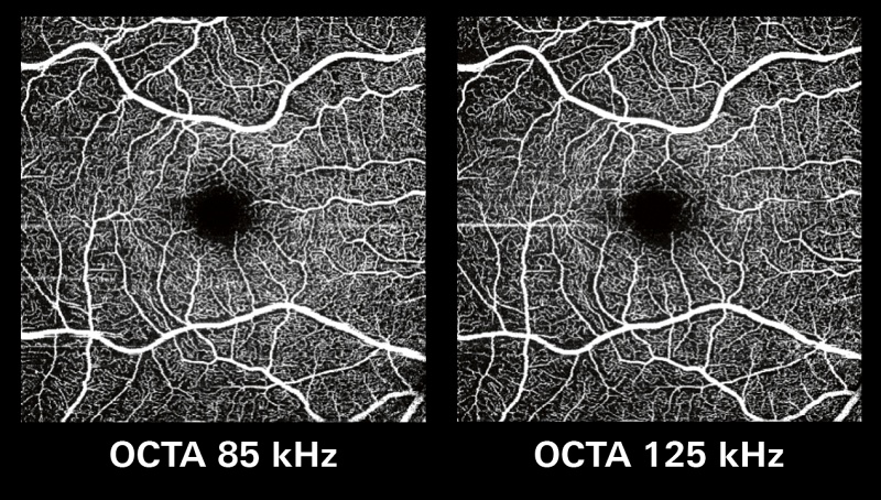 OCT angiography