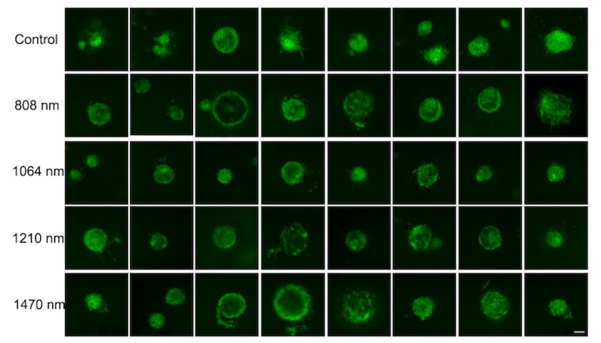 Non-linear imaging: plaques observed
