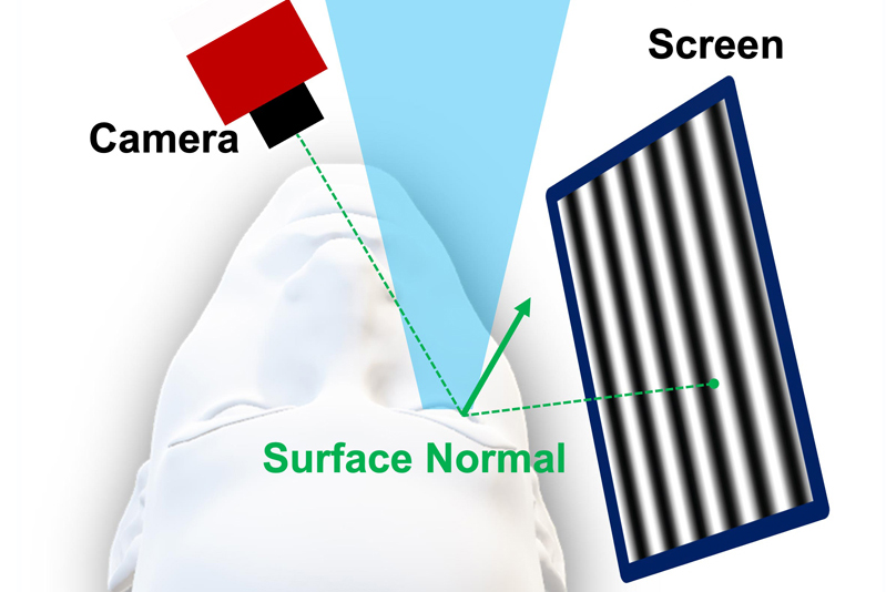 Camera records light patterns as they reflect off the eye’s surface.
