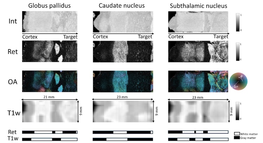 Position critical: DBS treatment
