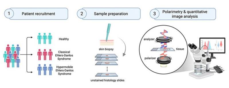 Label-free polarimetric analysis of EDS skin biopsies. Click for info.