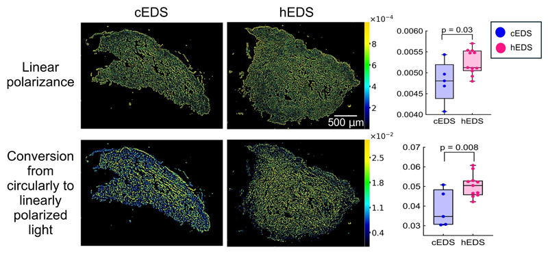 Representative polarization images to distinguish between cEDS and hEDS skin biopsies. Representative polarization images to distinguish between cEDS and hEDS skin biopsies.