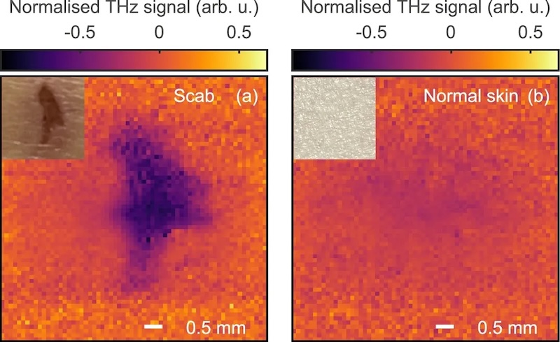 In vivo THz real-time imaging of scab on wound