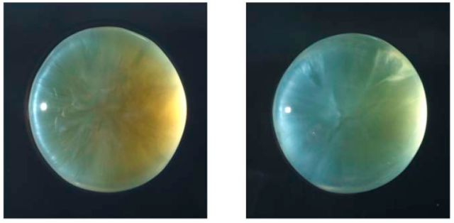 Spot the cataract Spot the cataract