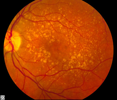 Age-related macular degeneration
