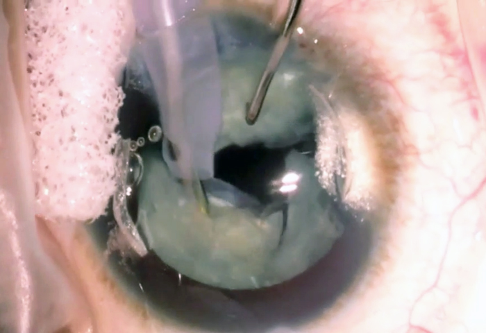 Going... Cataract broken up 