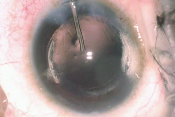 Gone... Cataract removal completed