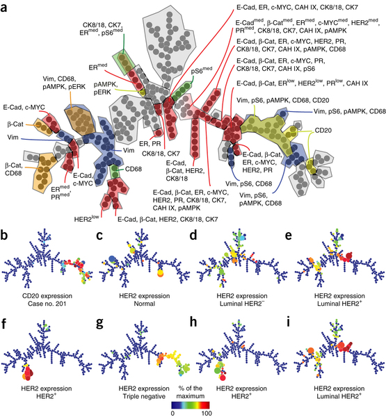 Zurich group's imaging mass cytometry analysis of tumor heterogeneity. Zurich group's imaging mass cytometry analysis of tumor heterogeneity.
