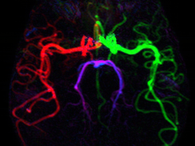 A simulation of blood flowing into the brain.