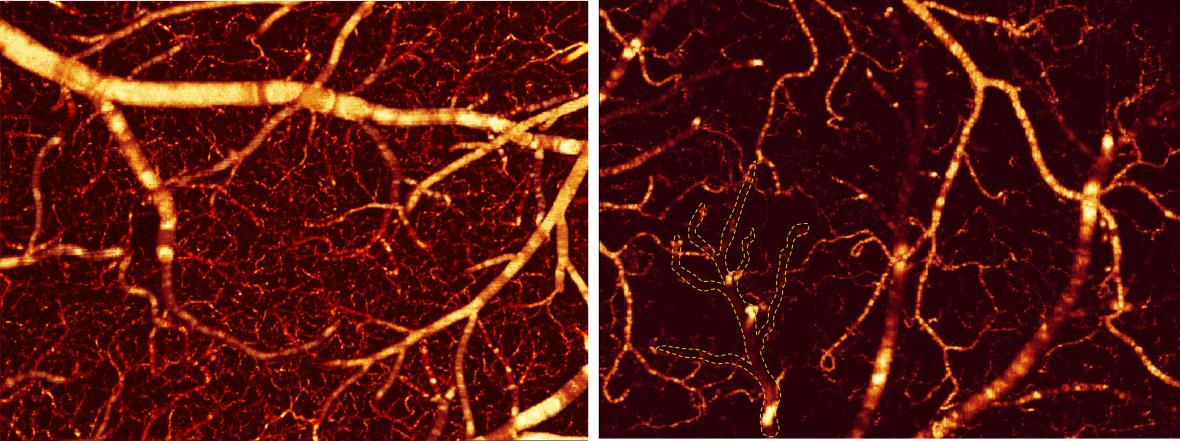 ODT of blood flow ODT of blood flow