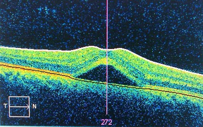 CSR diagnosis using optical coherence tomography CSR diagnosis using optical coherence tomography