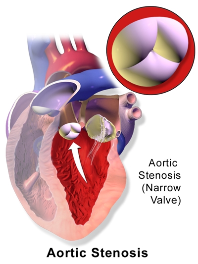 Aortic stenosis Aortic stenosis