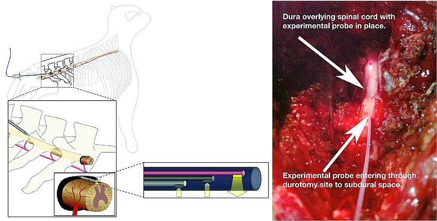 The spinal probe in position