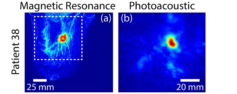 PA imaging and MRI comparison