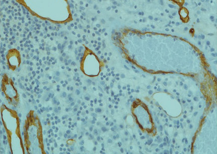 Revealed: Intra-lesion micro-vessels.