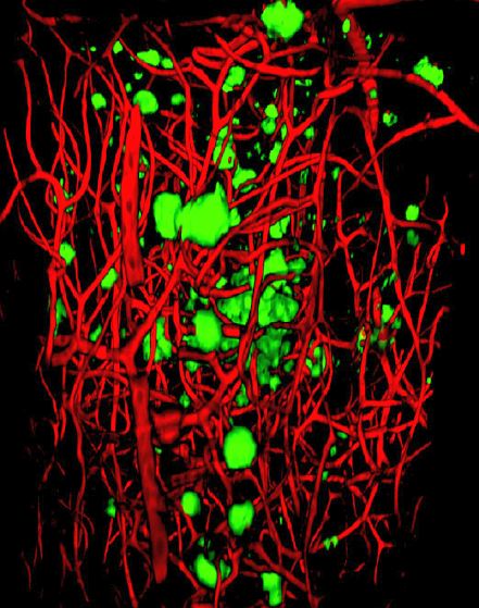 A clearer view of Alzheimer's