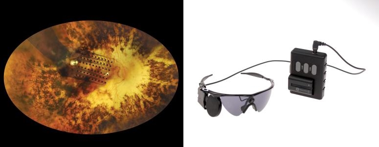The Argus II retinal prosthesis The Argus II retinal prosthesis