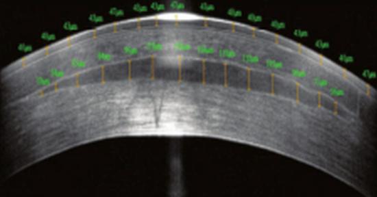 Clear vision: implants from donor corneas