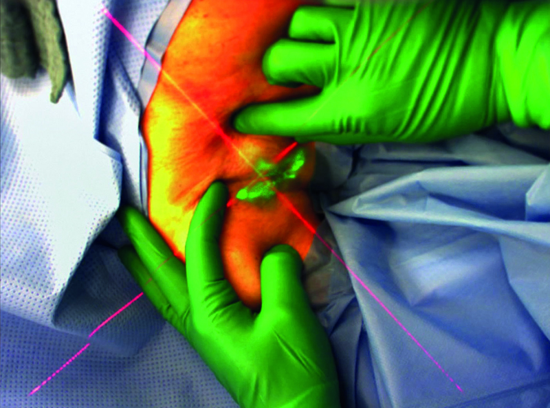 AR glasses enable surgeon to precisely locate the lymph node during surgery.