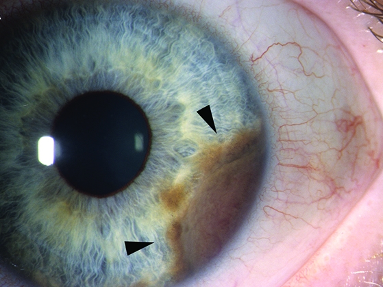 Uveal melanoma: clinical presentation