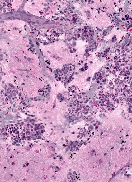 Raman histology: a faster diagnosis