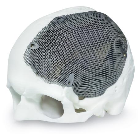 AM implants: made to measure