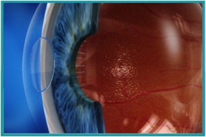 Corneal implant