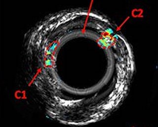 Imaging cholesterol: photoacoustic radar