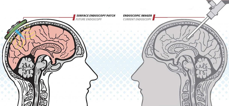 New approach (above, left) uses ultrasound for guiding light through tissue for noninvasive endoscopic imaging of deep organs and tissues. 