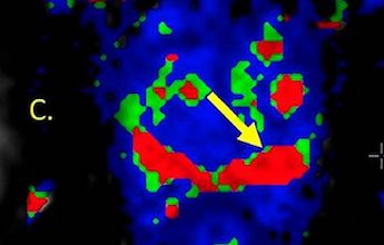 Hot spots: localized ablation