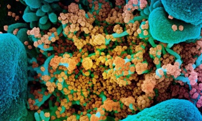 Colorized SEM of a dying cell (blue) infected with SARS-CoV-2 (yellow).