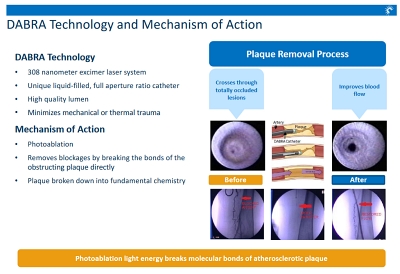 Plaque photoablation